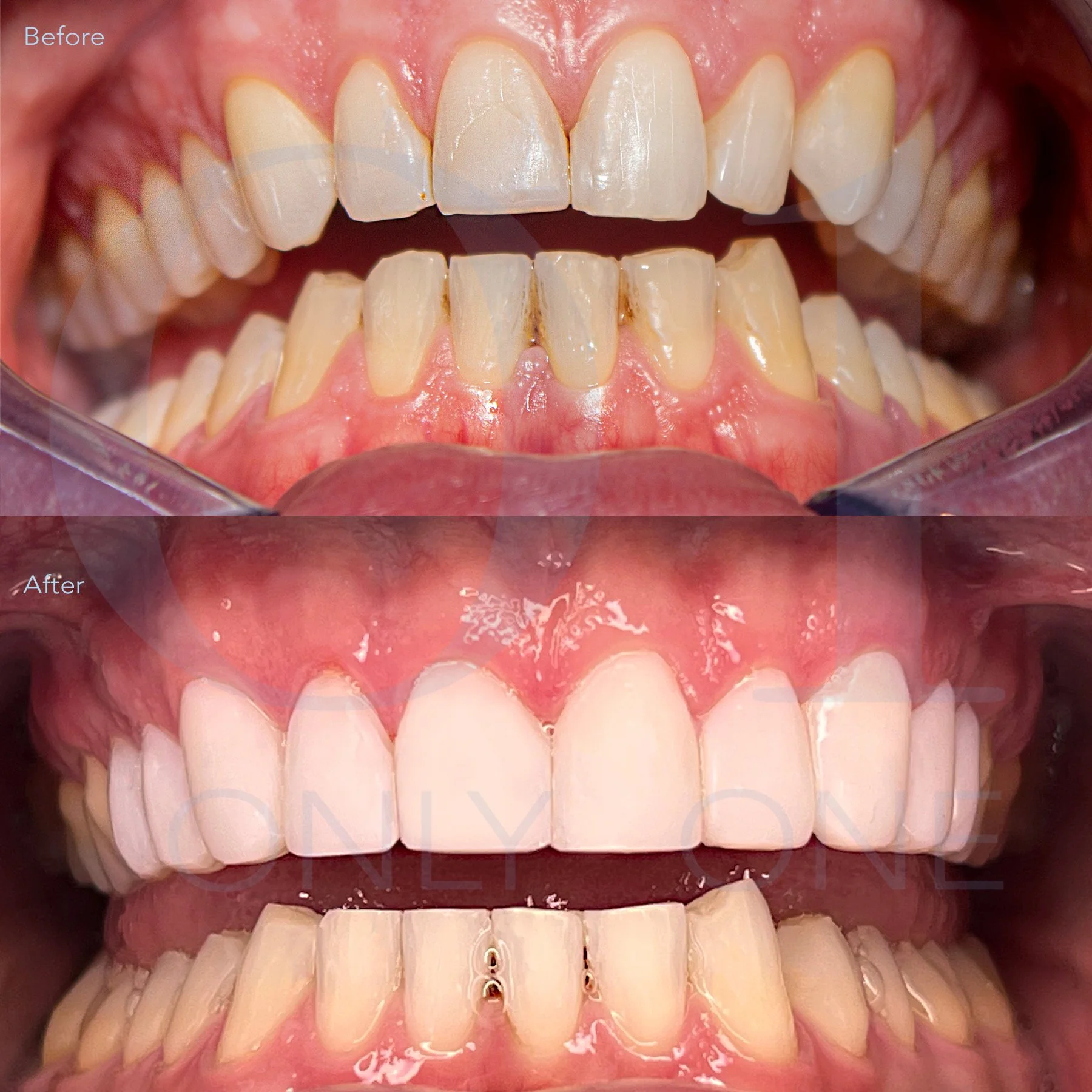 Invisalign, 10 Composite bondings, 8 upper teeth