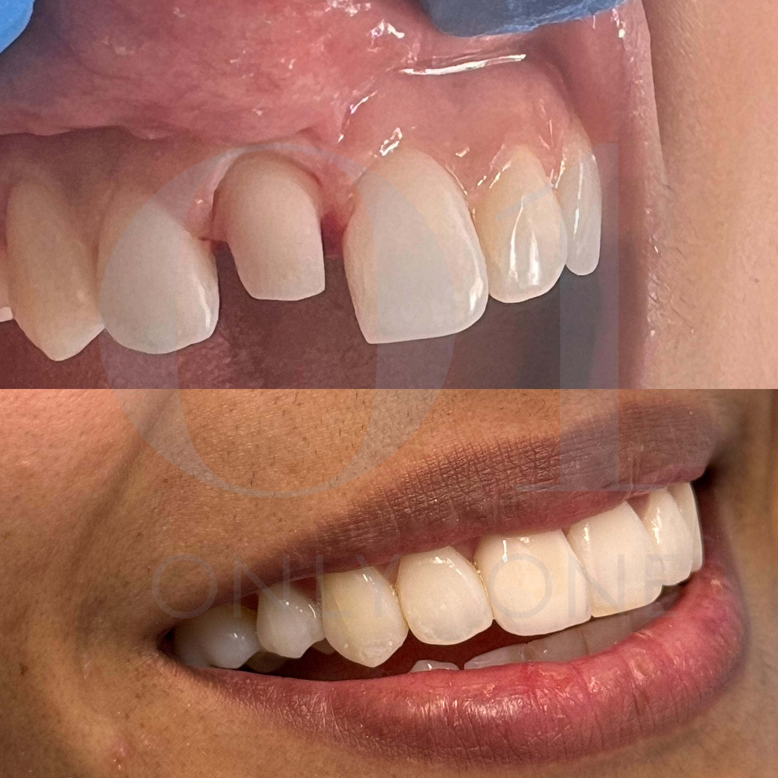 Replacement of upper right 1 crown after accident breaking tooth