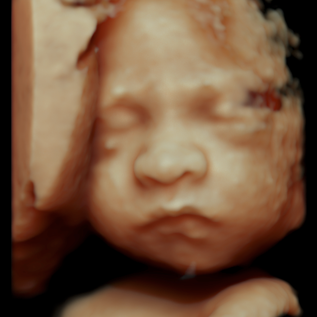 Close-up of a 3D ultrasound image of a baby's face.