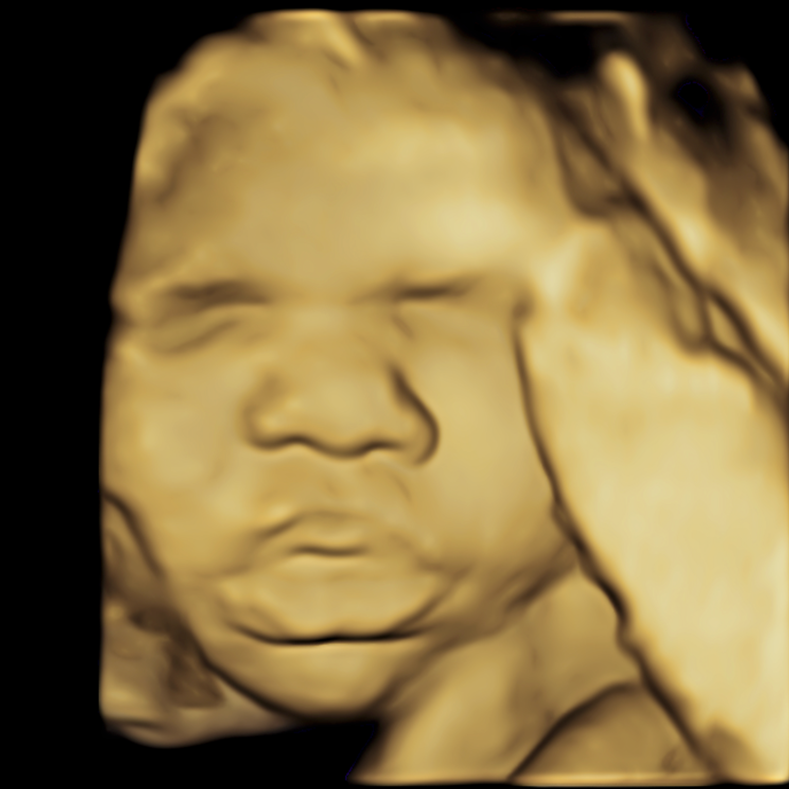 Close-up of a 3D ultrasound image of a baby's face in shades of yellow and black.