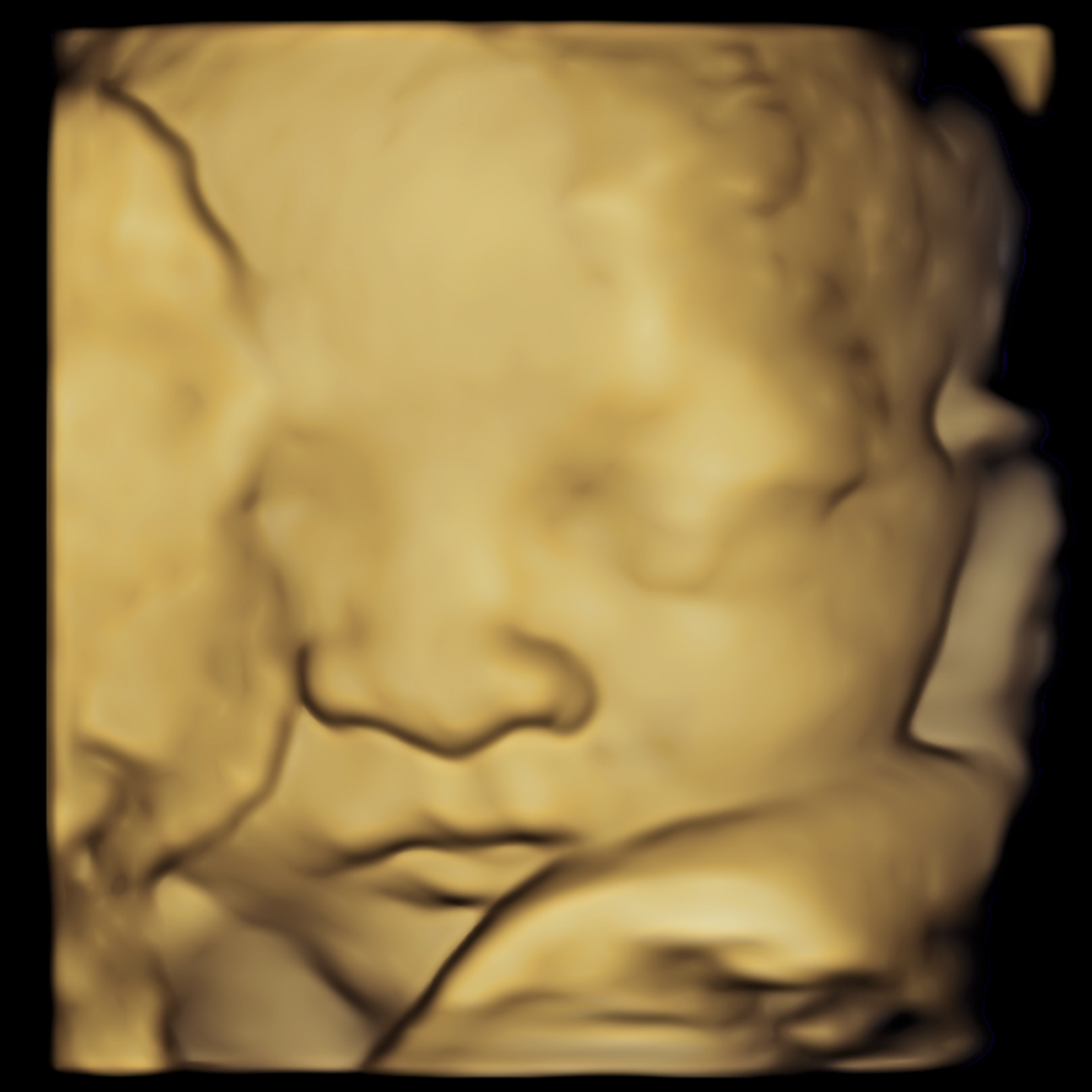A 3D ultrasound scan of a fetus's face.