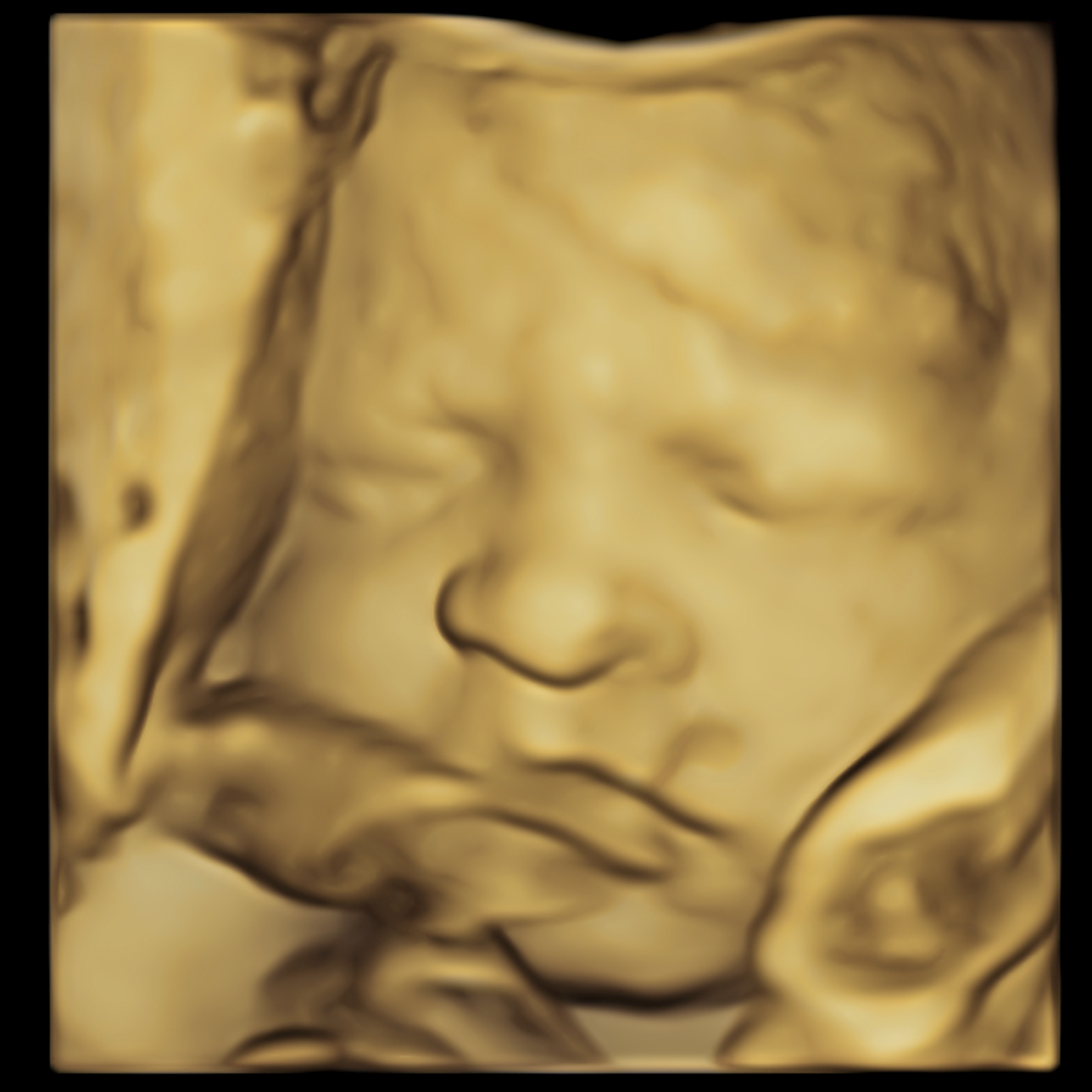 Close-up of a 3D ultrasound image of a baby’s face.