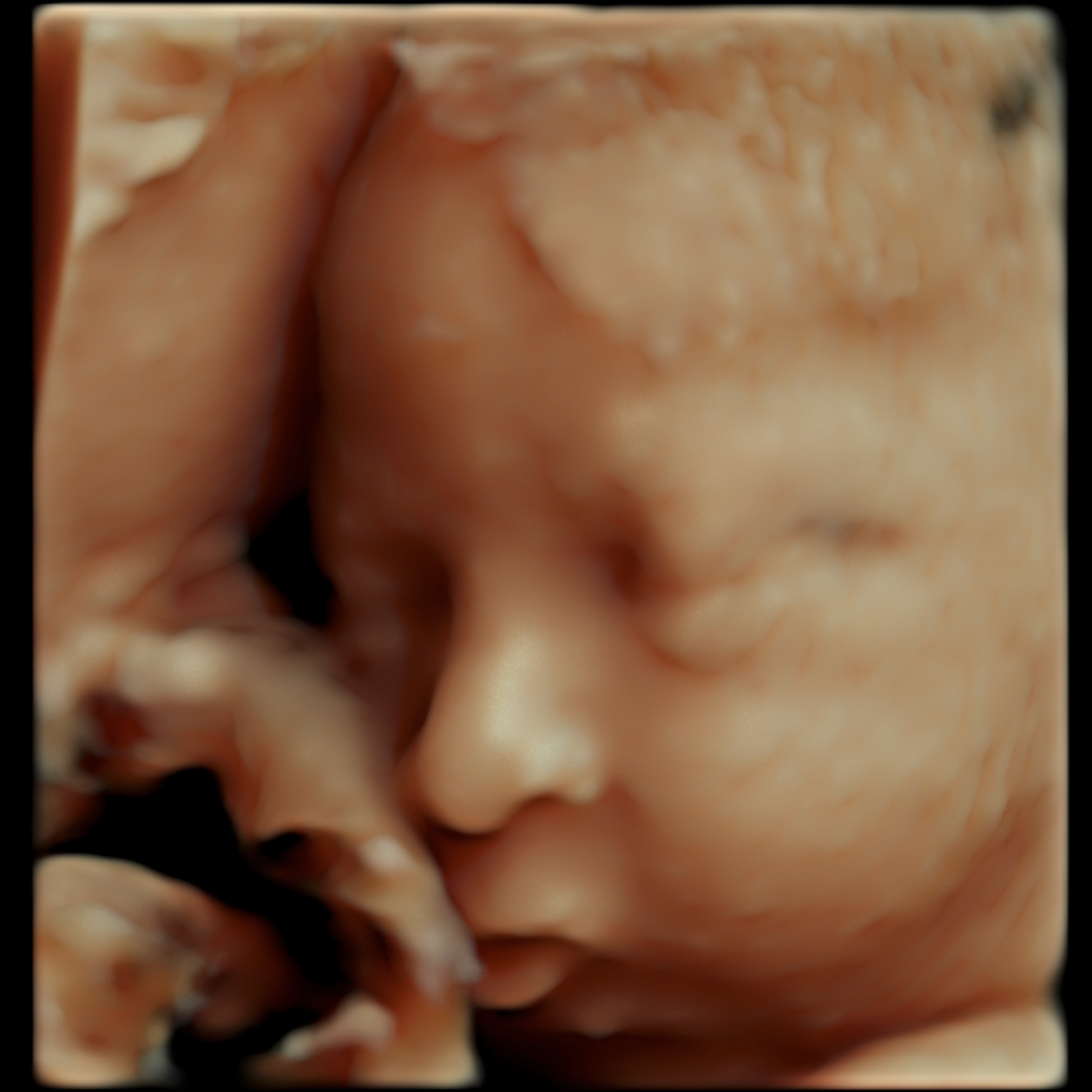 Close-up of a 3D ultrasound image of a fetus's face.