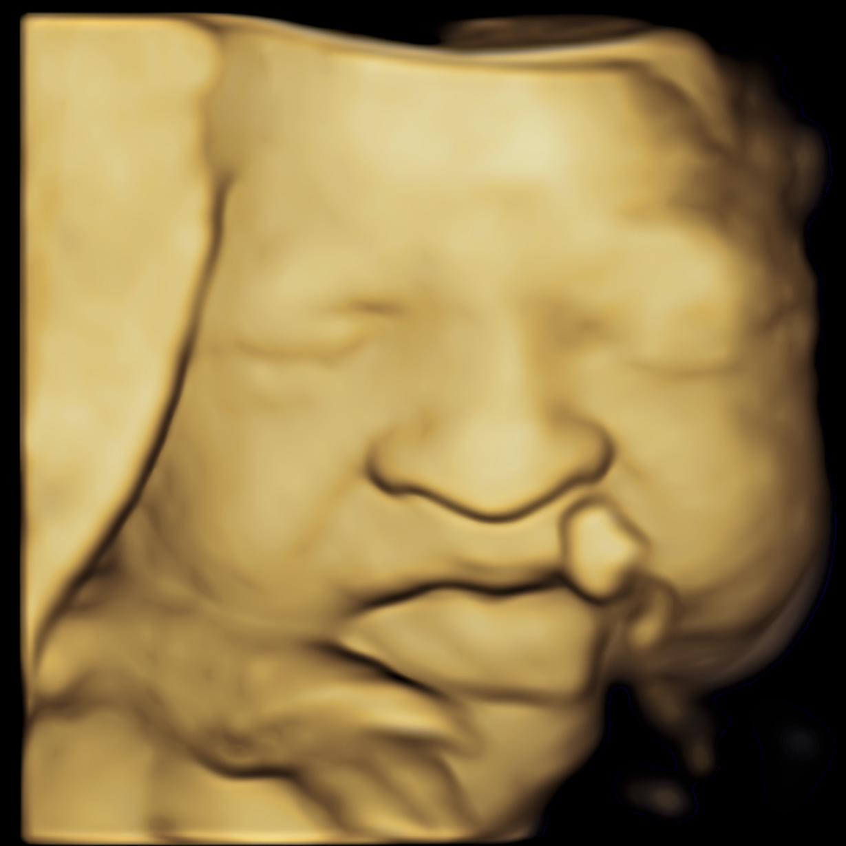 A 3D ultrasound image of a baby's face with closed eyes and a finger resting near the lips.