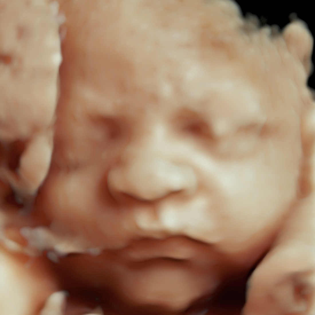 Close-up of a newborn baby's face with eyes closed and hands resting on head.