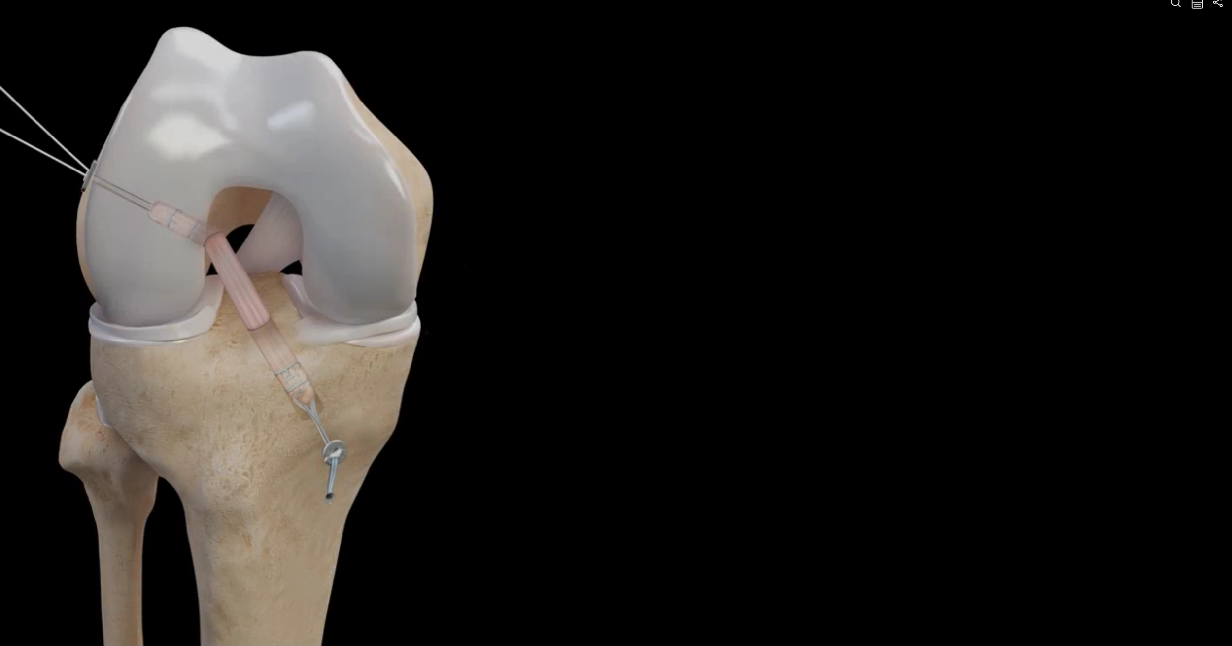 Medical illustration demonstrating an all-inside ACL reconstruction using a soft-tissue graft for the treatment of an ACL tear.