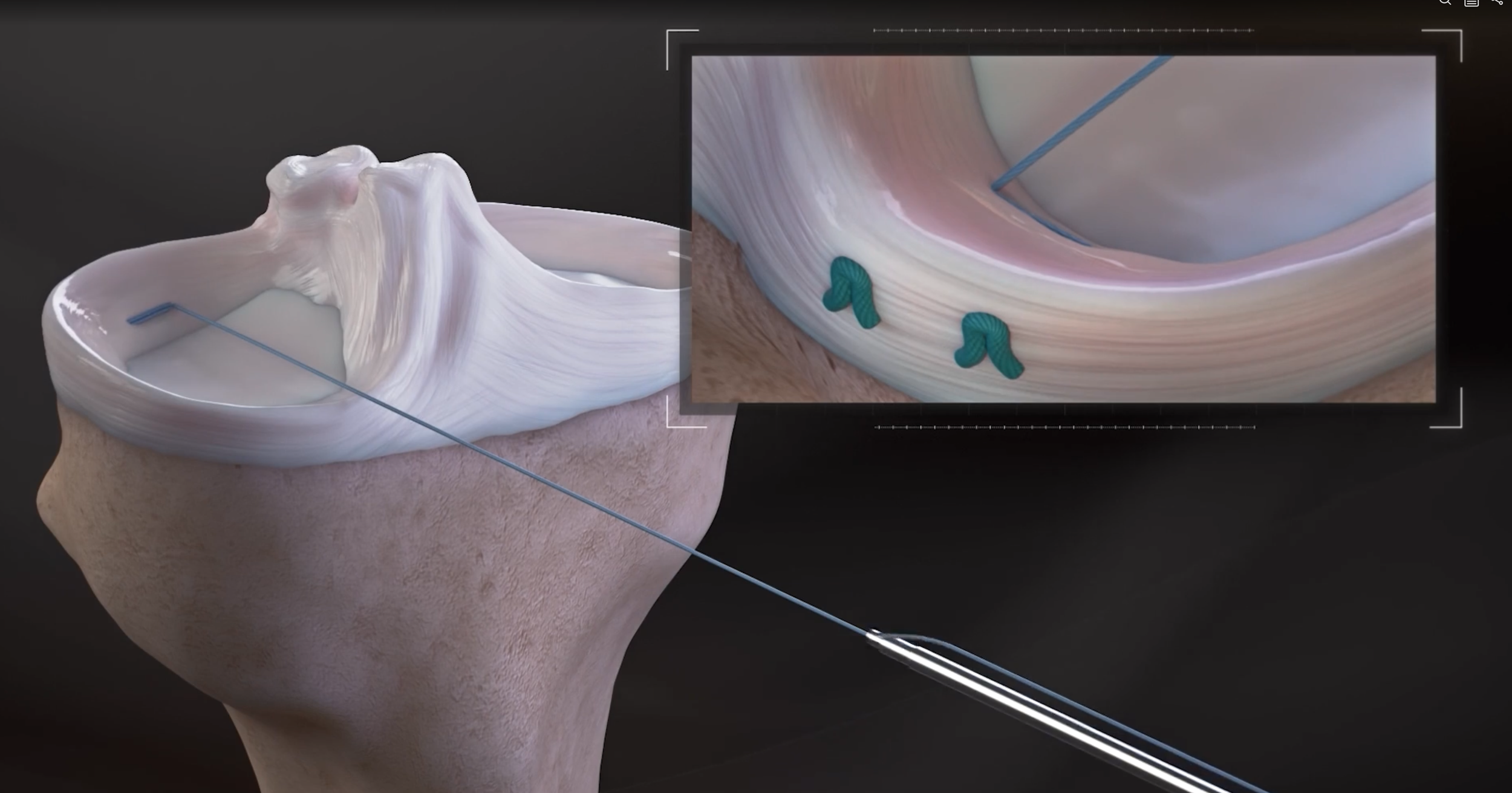 Medical illustration showing a detailed view demonstrating an all-inside meniscus repair to treat a meniscus tear.