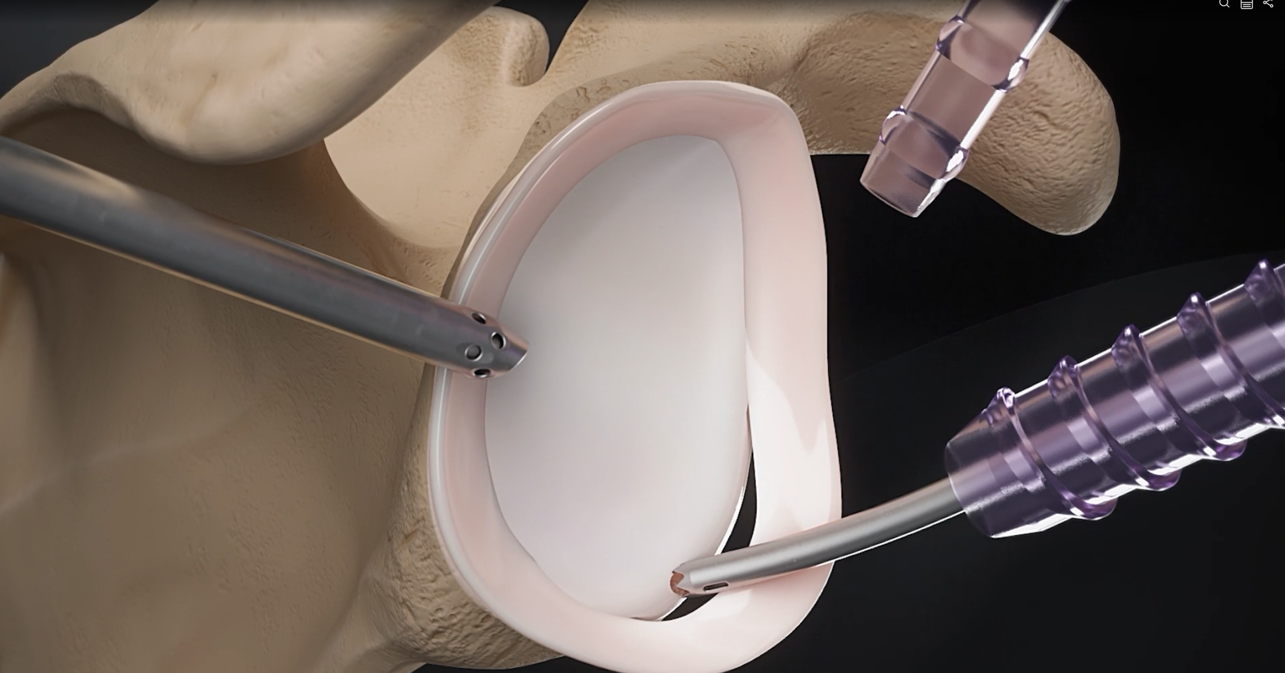 Medical procedure scene with a surgical light, medical instruments, and a sterile environment demonstrating an anterior labral repair for the treatment of shoulder instability.