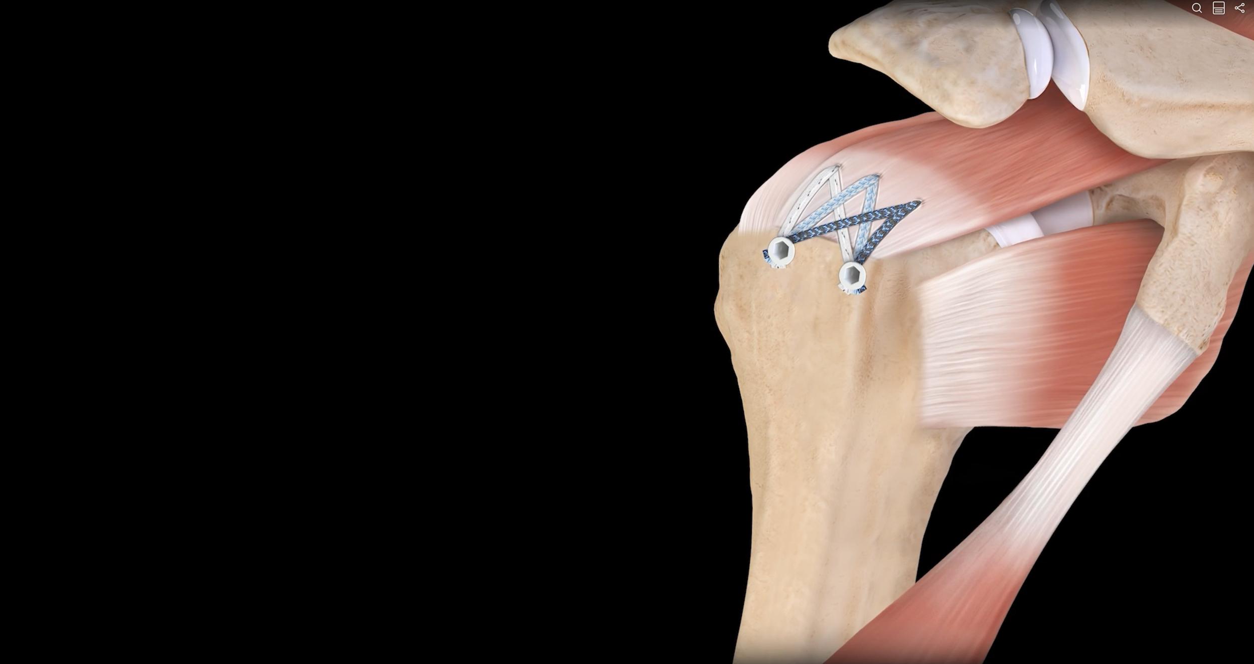 Detailed anatomical illustration demonstrating a rotator cuff repair for the treatment of a rotator cuff tear.