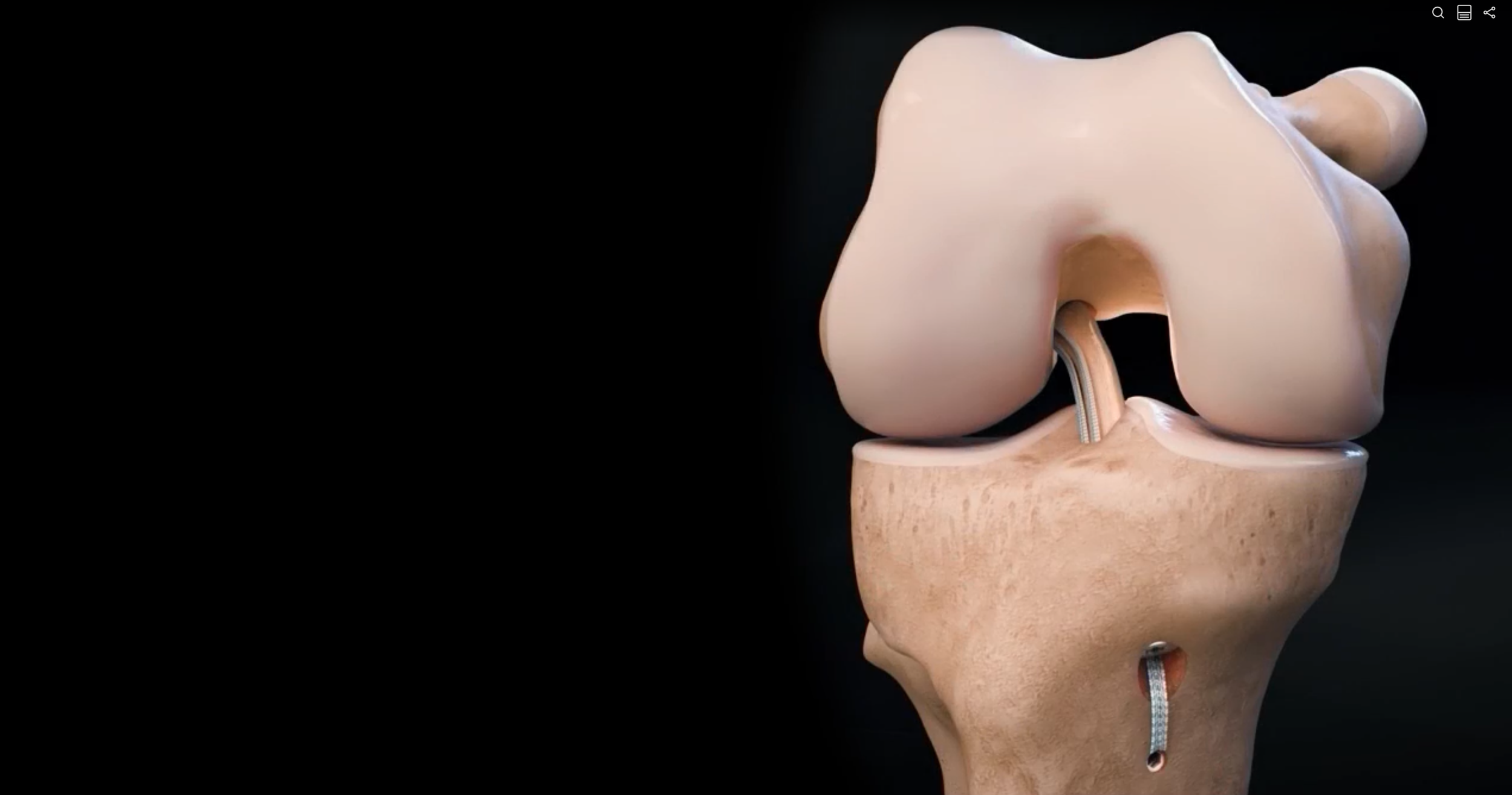 A medical model of a human knee demonstrating an ACL reconstruction using a bone-tendon-bone (BTB) graft for the treatment of an ACL tear.