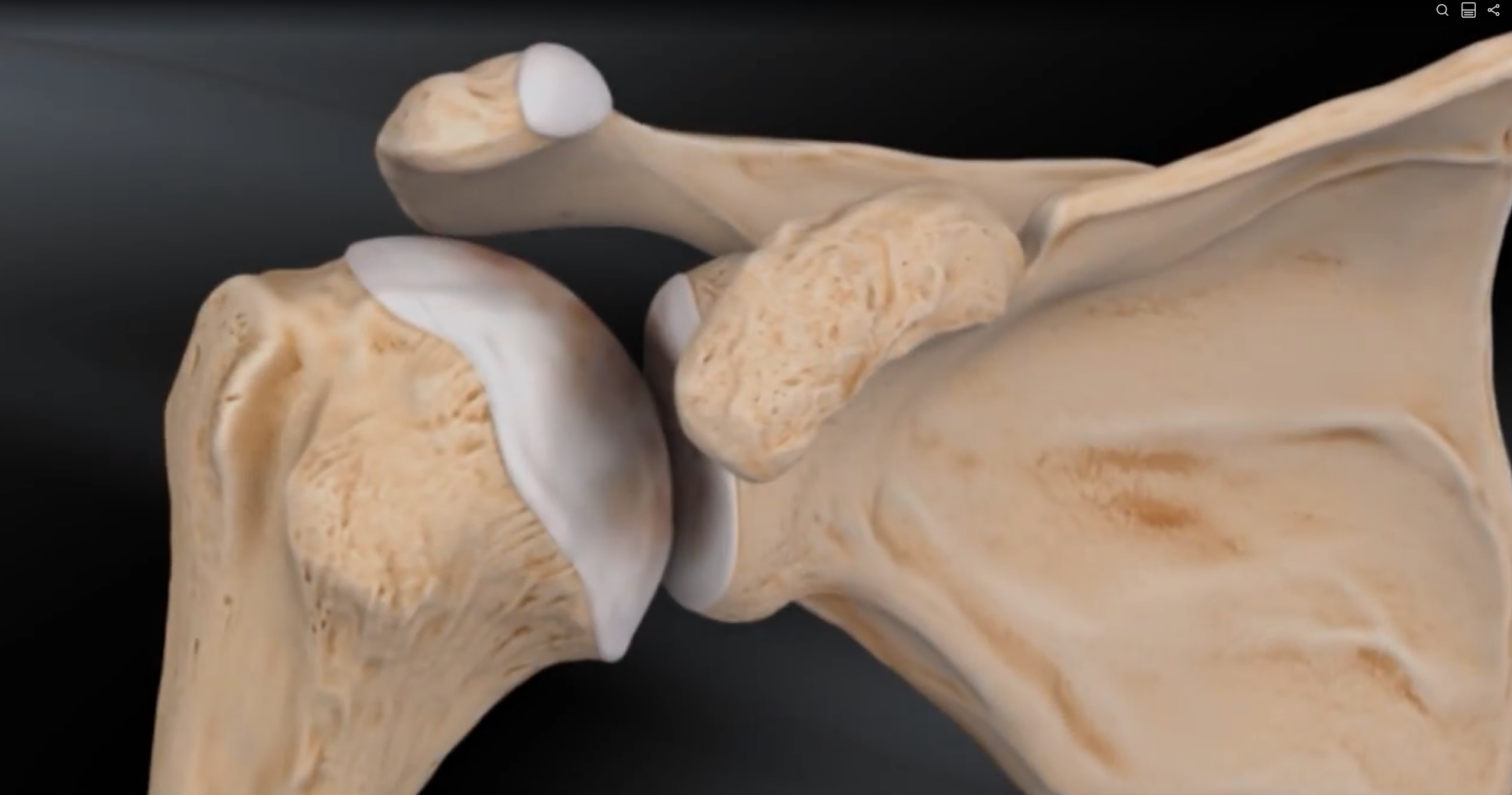 A scientific model of a reverse shoulder replacement for the treatment of shoulder arthritis.