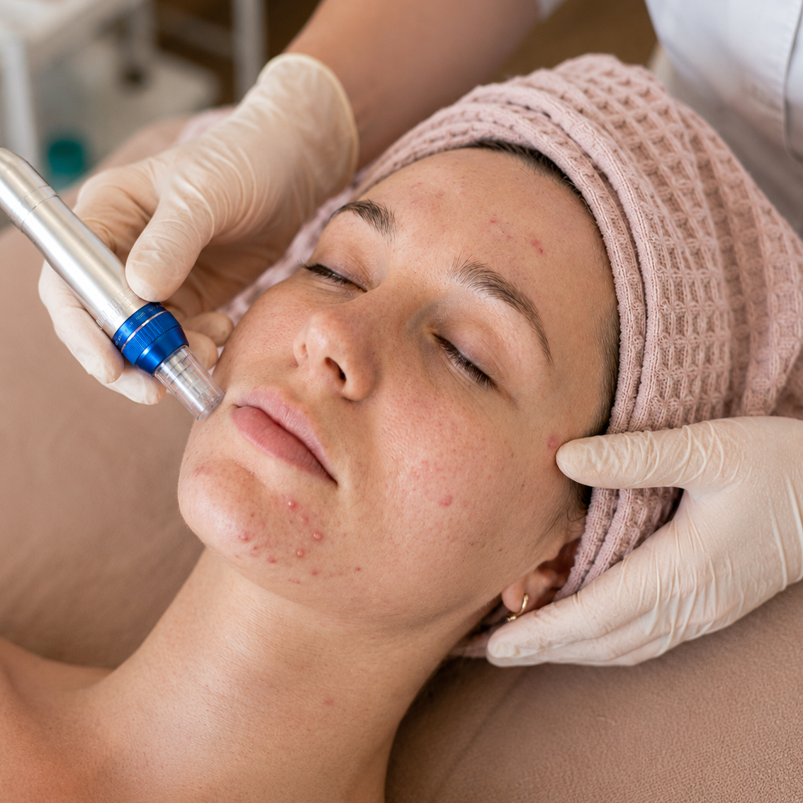 Foothills Acupuncture Lakewood | Denver Acupuncture- Cosmetic Acupuncture, Microneedling, Nanoneedling