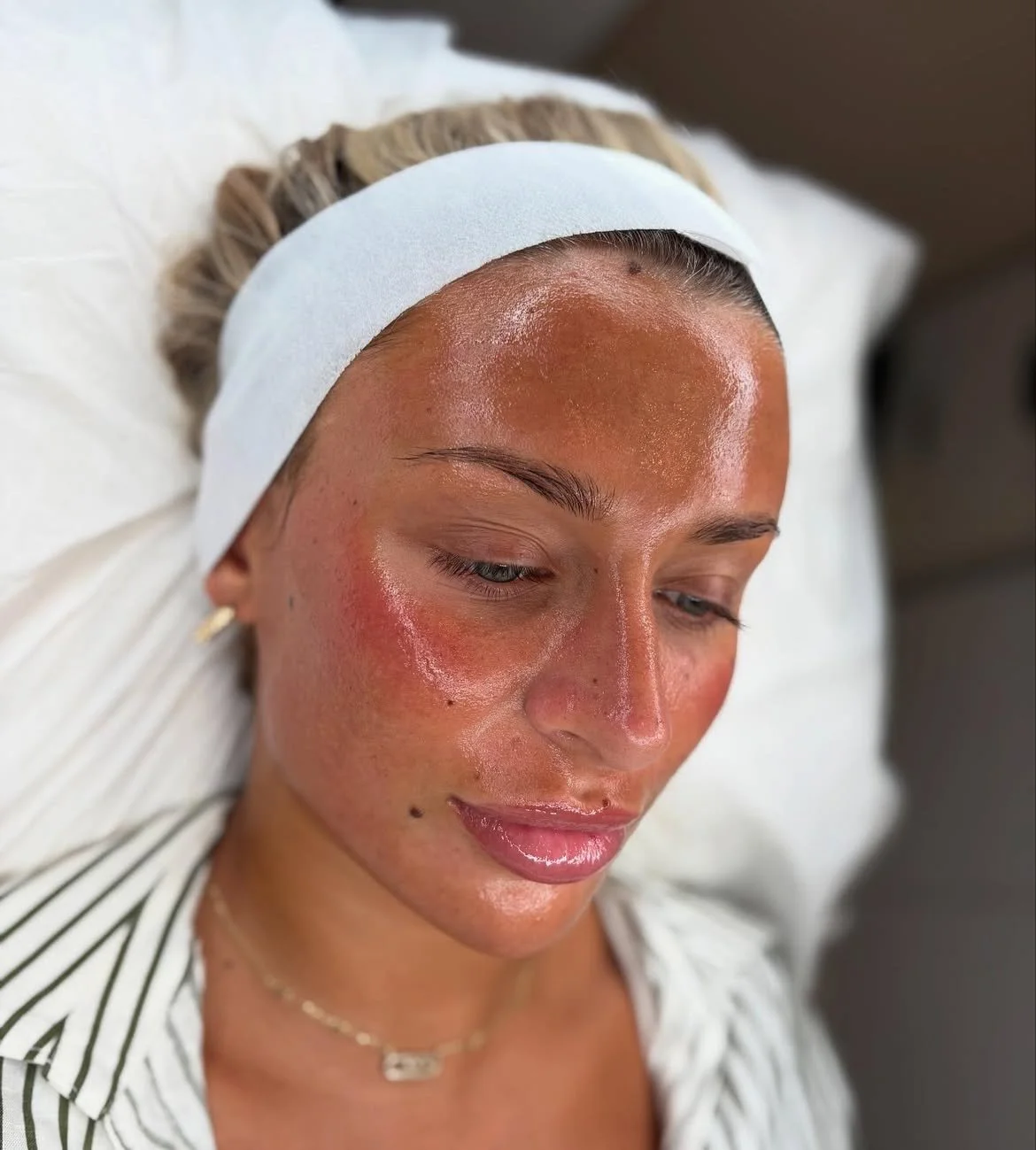 Bespoke facial treatment results at Laser & Skin Studio in Rainham, Kent