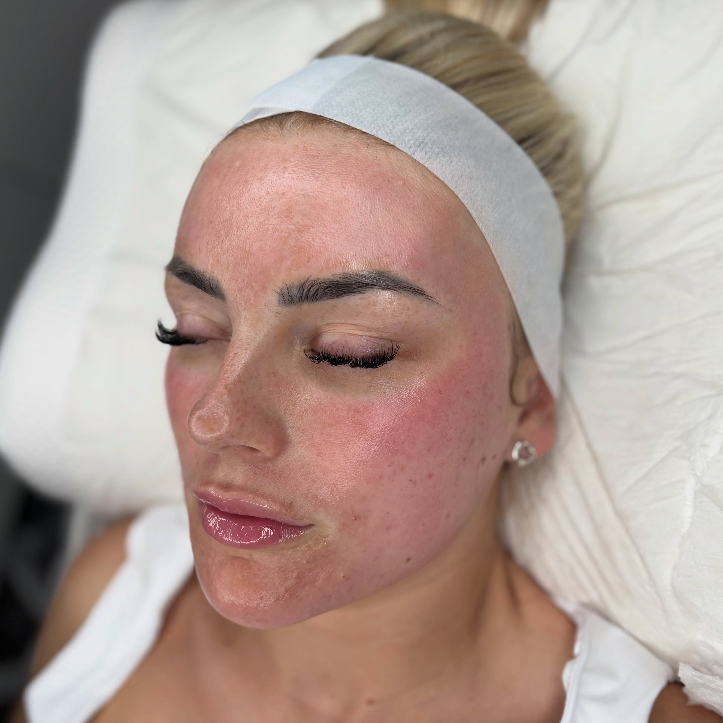 When all those pre-wedding facials are now paying off, helping brides achieve their best skin ready for their big day really is my favourite thing🥹👰🏼