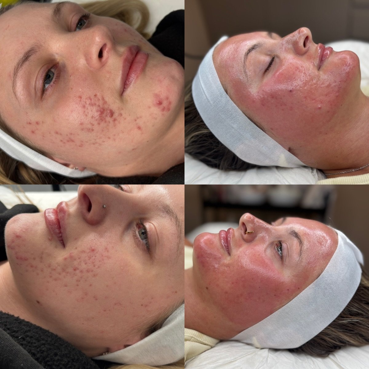 ✨ Real progress is built, not rushed. ✨
March 2026 ➡️ July 2026.

When we first started, our priority wasn&rsquo;t aggressive treatments&mdash;it was repairing the skin barrier, reducing inflammation, and calming active breakouts. Treating acne witho