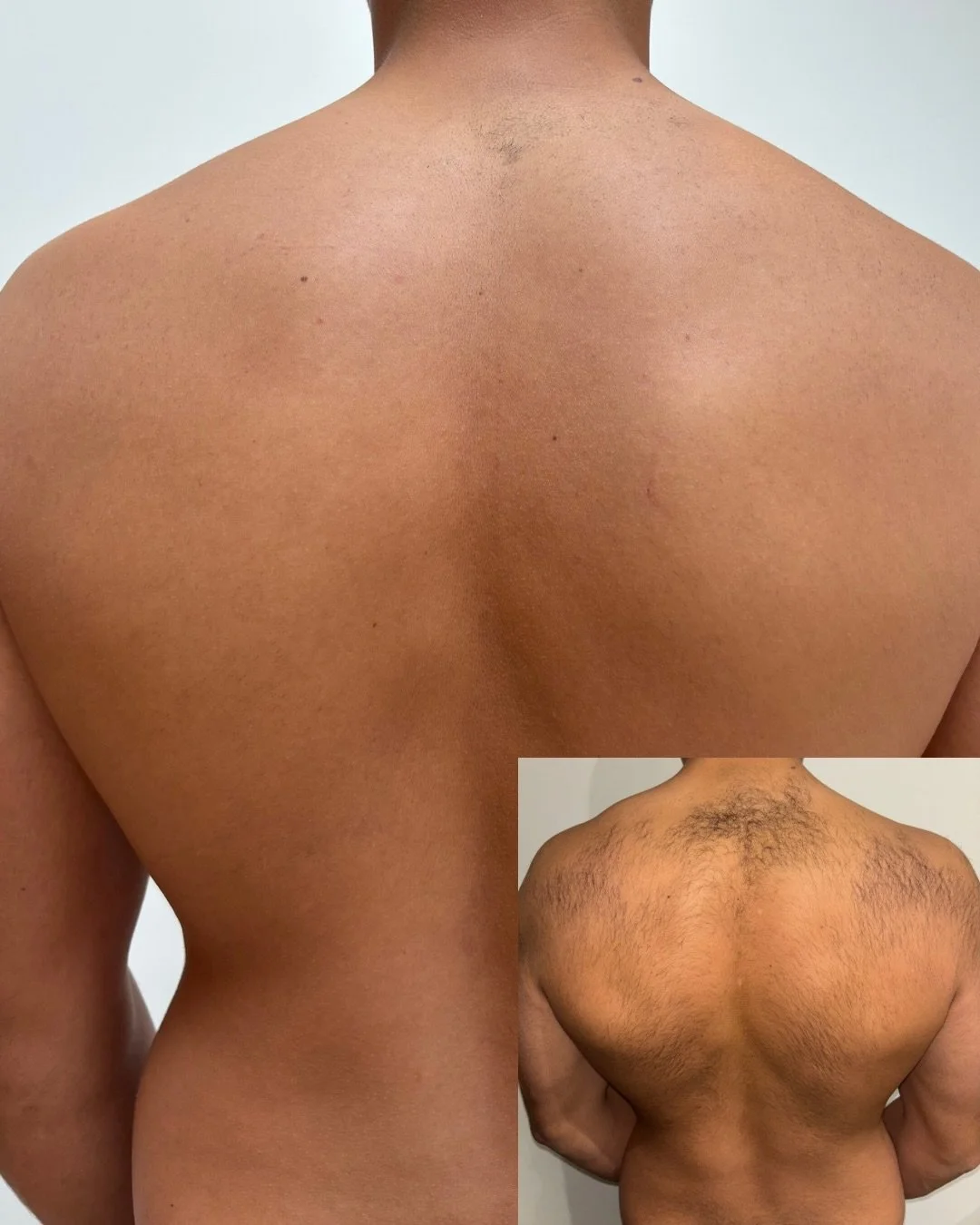 ONE session. 6 weeks later. No shaving. The difference speaks for itself👏🏽

A look at the hair growth after just ONE medical-grade laser hair removal treatment on the back.

✨ Noticeably reduced hair density
✨ Slower, finer regrowth
✨ Smoother-look