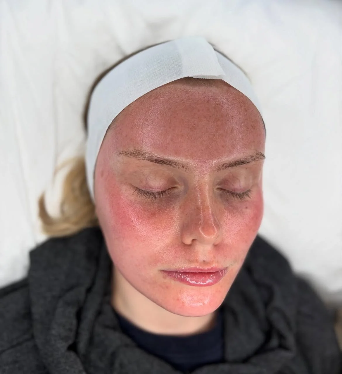 Client receiving an advanced skin treatment at Laser & Skin Studio Kent