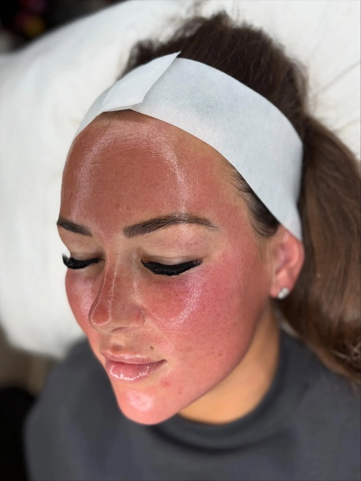 Advanced facial treatment results at Laser & Skin Studio in Rainham, Kent