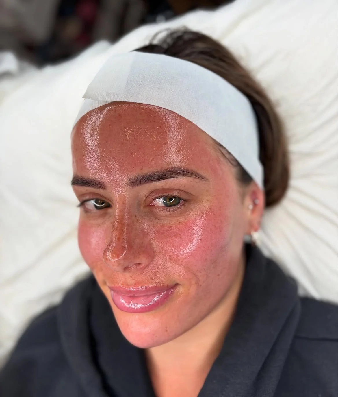 Client after an advanced skin treatment at Laser & Skin Studio Kent
