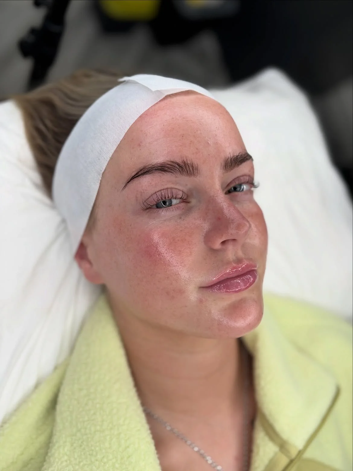 Client after an advanced facial treatment at Laser & Skin Studio Kent