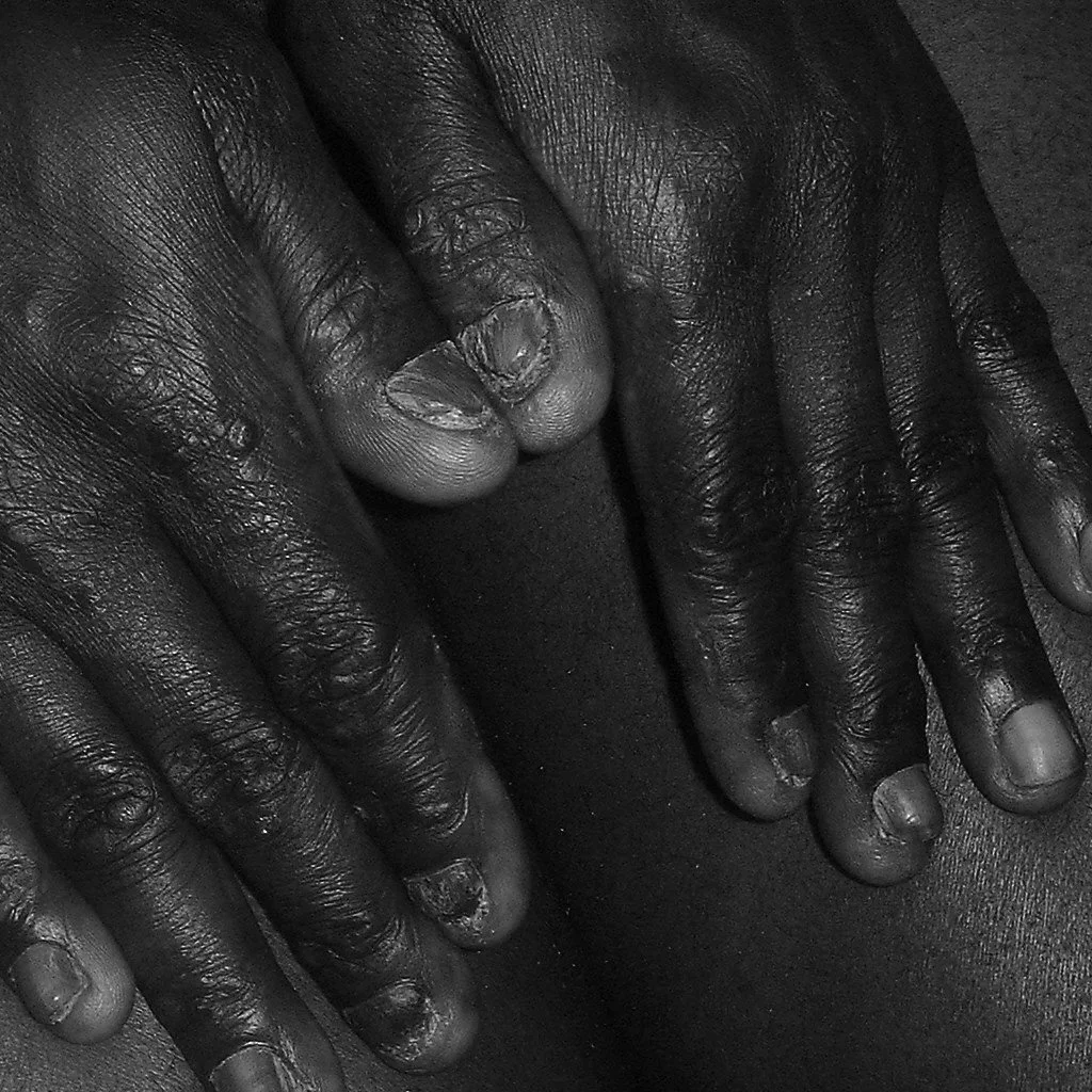 Adult EB Hands