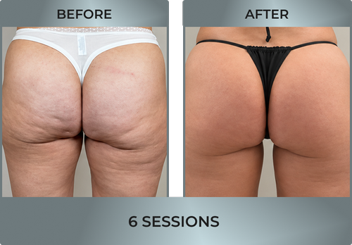 Cellulite Reduction