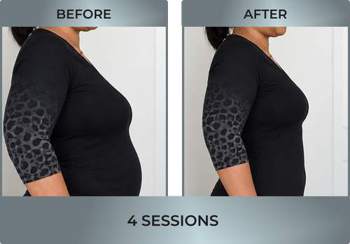 fat reduction2.webp