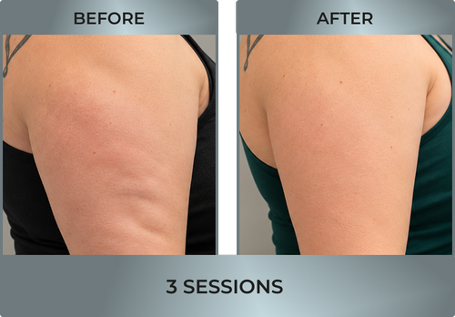 cellulite reduction2.webp