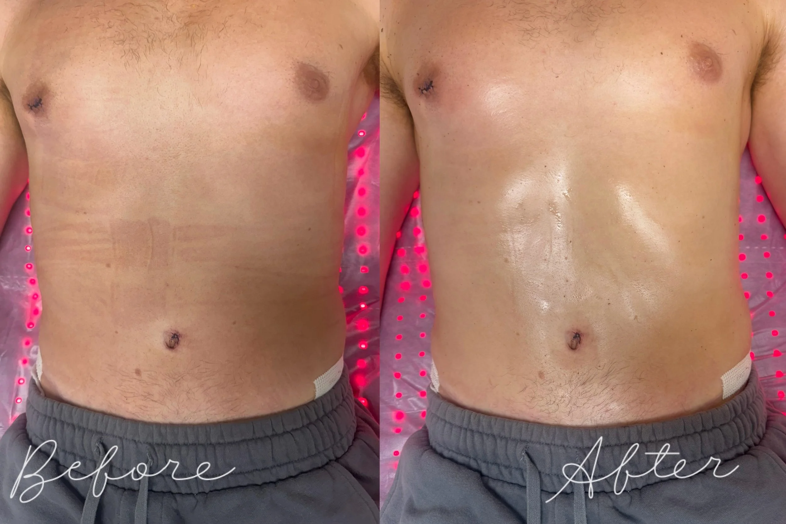 Look at the immediate difference lymphatic drainage can make just 24 hours post-op after a scar revision and lipo by @drgarlick My students got to see this incredible contour shift happen in real time during our hands on training!

What does this hav