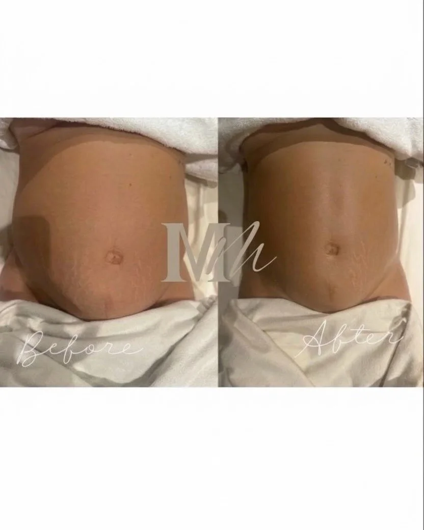 She is 8 months pregnant &amp; still has abs after her lymphatic drainage massage. 

Link in bio to book. 🤰✨