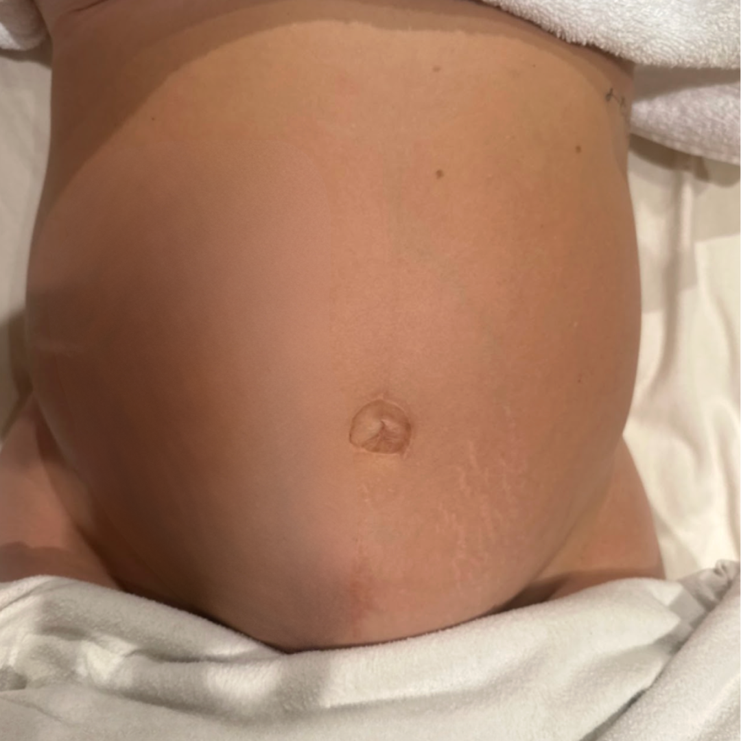 Close-up of a pregnant belly with a visible belly button, partially covered by a white towel, and some blemishes or stretch marks.