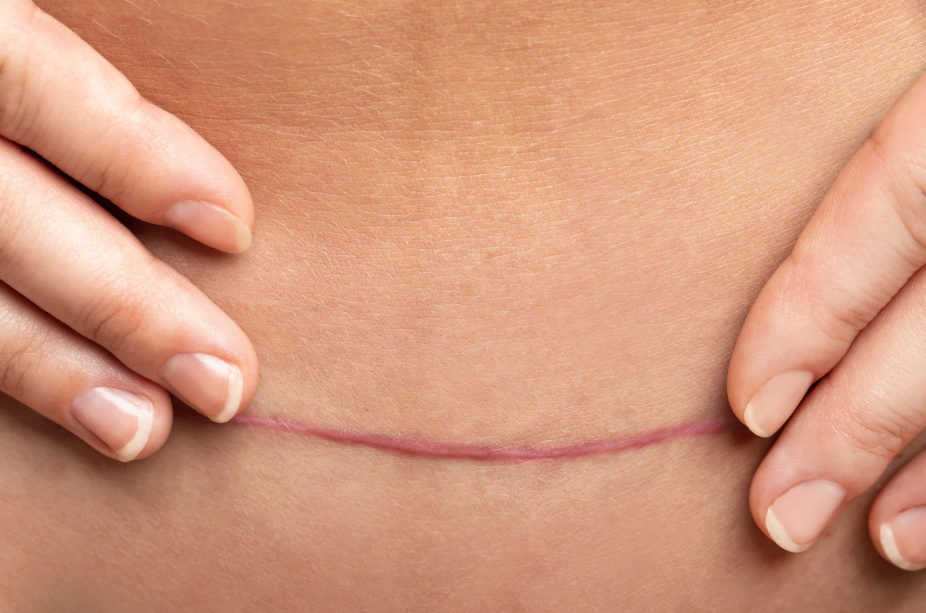 Close-up of a person's belly with a surgical scar, being held by two hands.