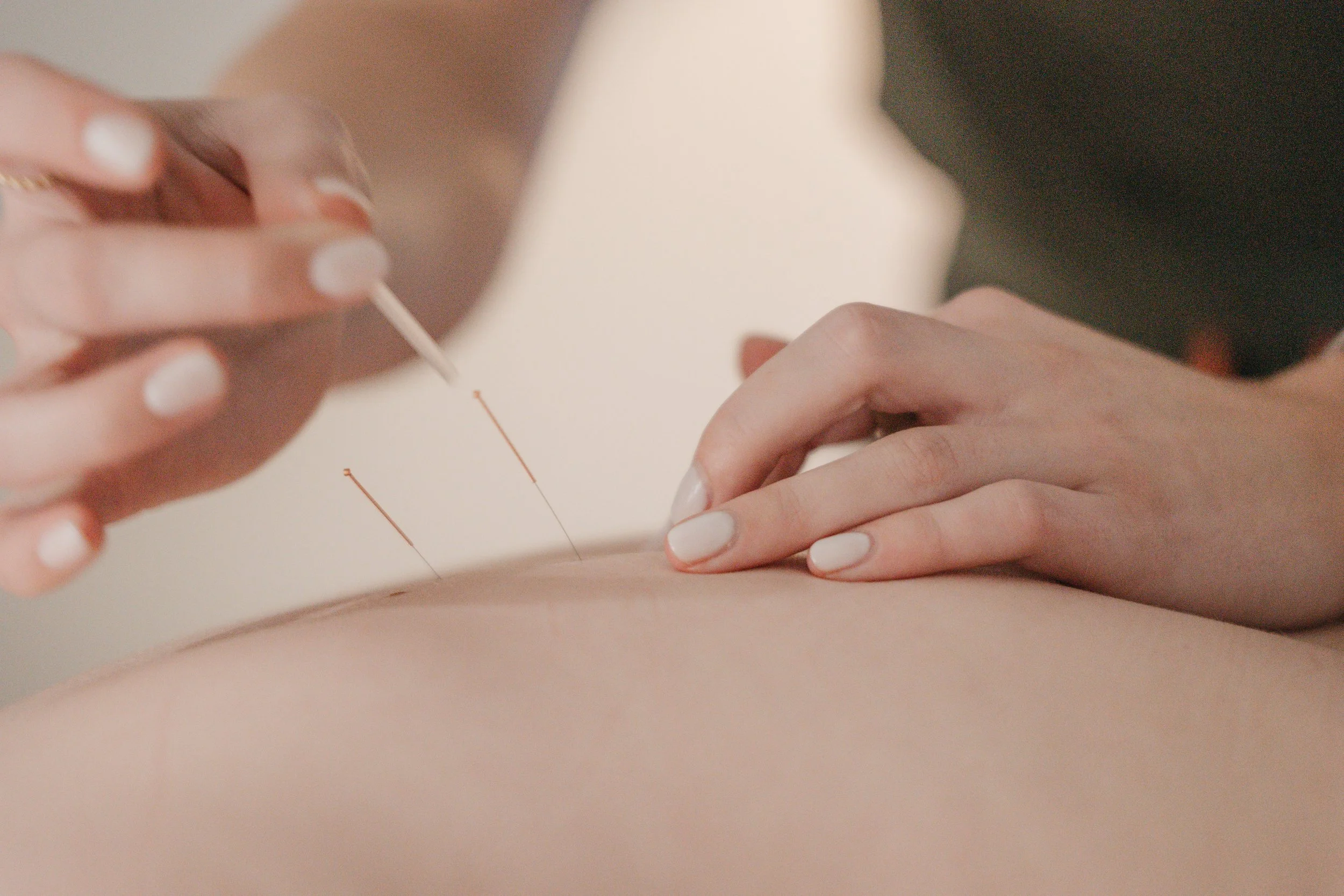 Close-up of a person's hand receiving an acupuncture treatment with three thin, copper acupuncture needles inserted into skin.