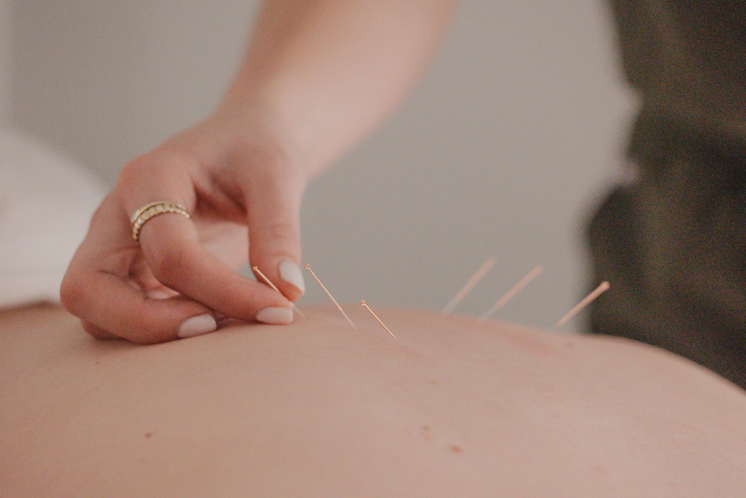 Close-up of a person receiving acupuncture, with multiple fine needles inserted into their skin, and the hand of the practitioner adjusting one of the needles.