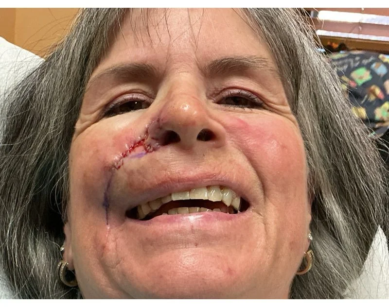 Close-up of a woman's face showing swelling and a surgical scar on her cheek, with visible stitches and bruising.