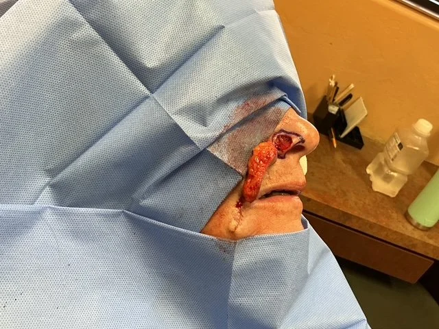 A person in surgical attire lying on an operating table with visible blood and an oral injury, possibly in a medical or surgical setting.