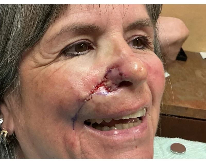 Close-up of a woman's face with a large surgical scar and stitches near her nose and cheek, showing signs of healing.