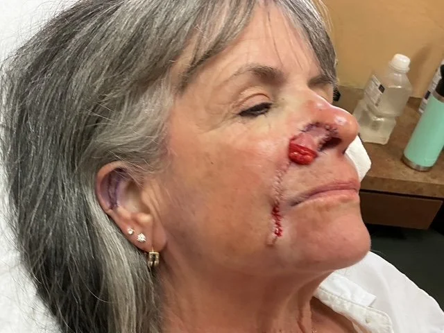 An older woman with gray hair in a hospital bed has a large injury on her right cheek, with swelling and bruising, and looks to be resting or recovering.