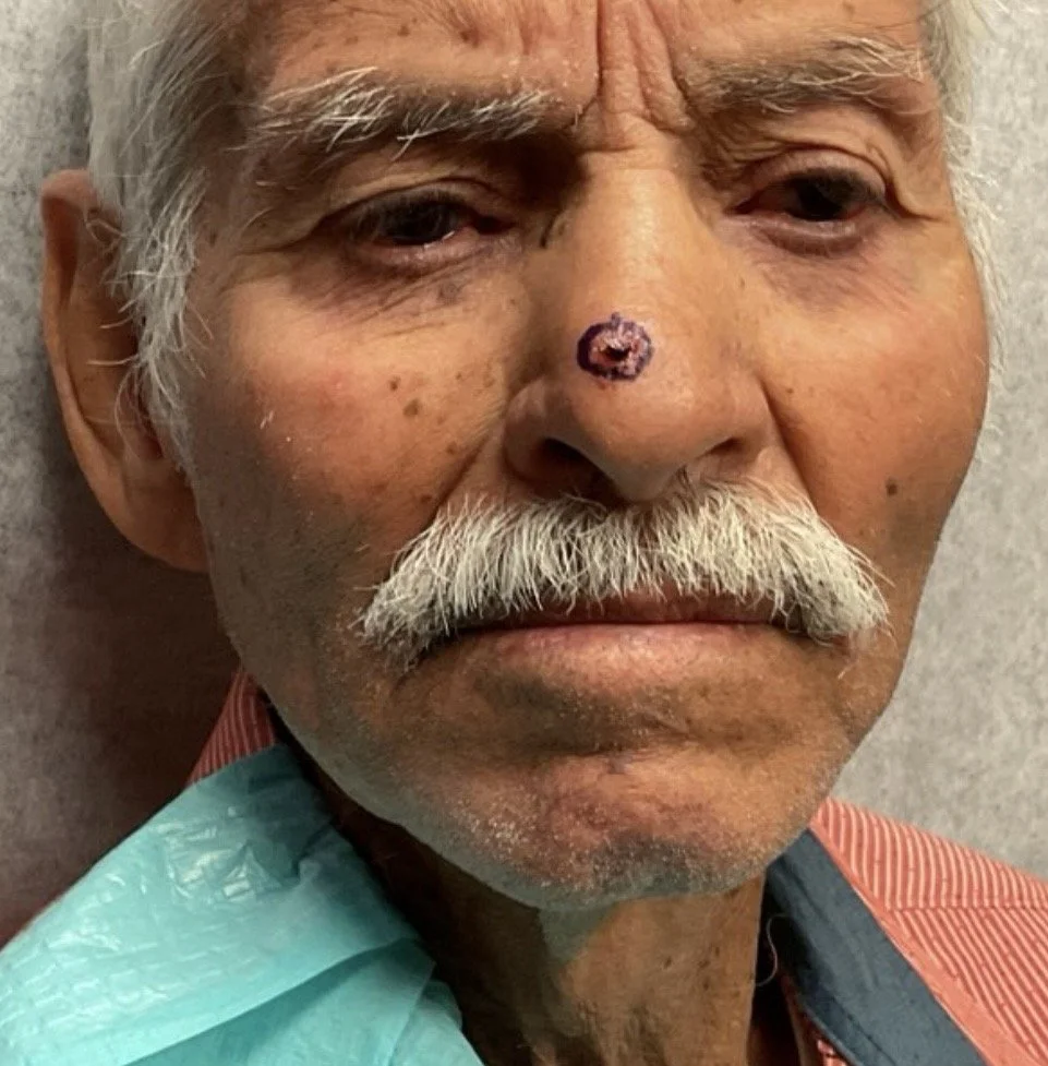 Close-up of an elderly man's face with a healing wound on his nose.