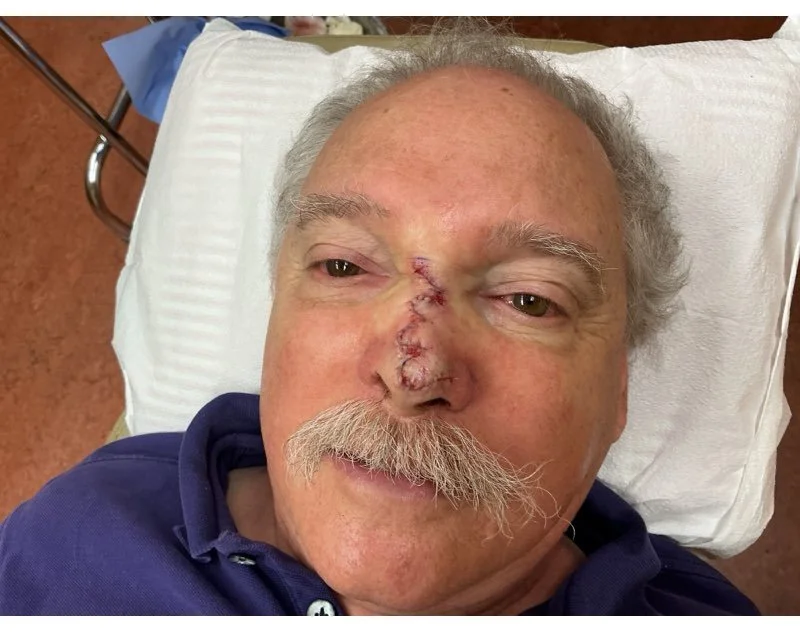 An elderly man with a mustache lying in a hospital bed, showing a large healed and stitched wound on his nose.