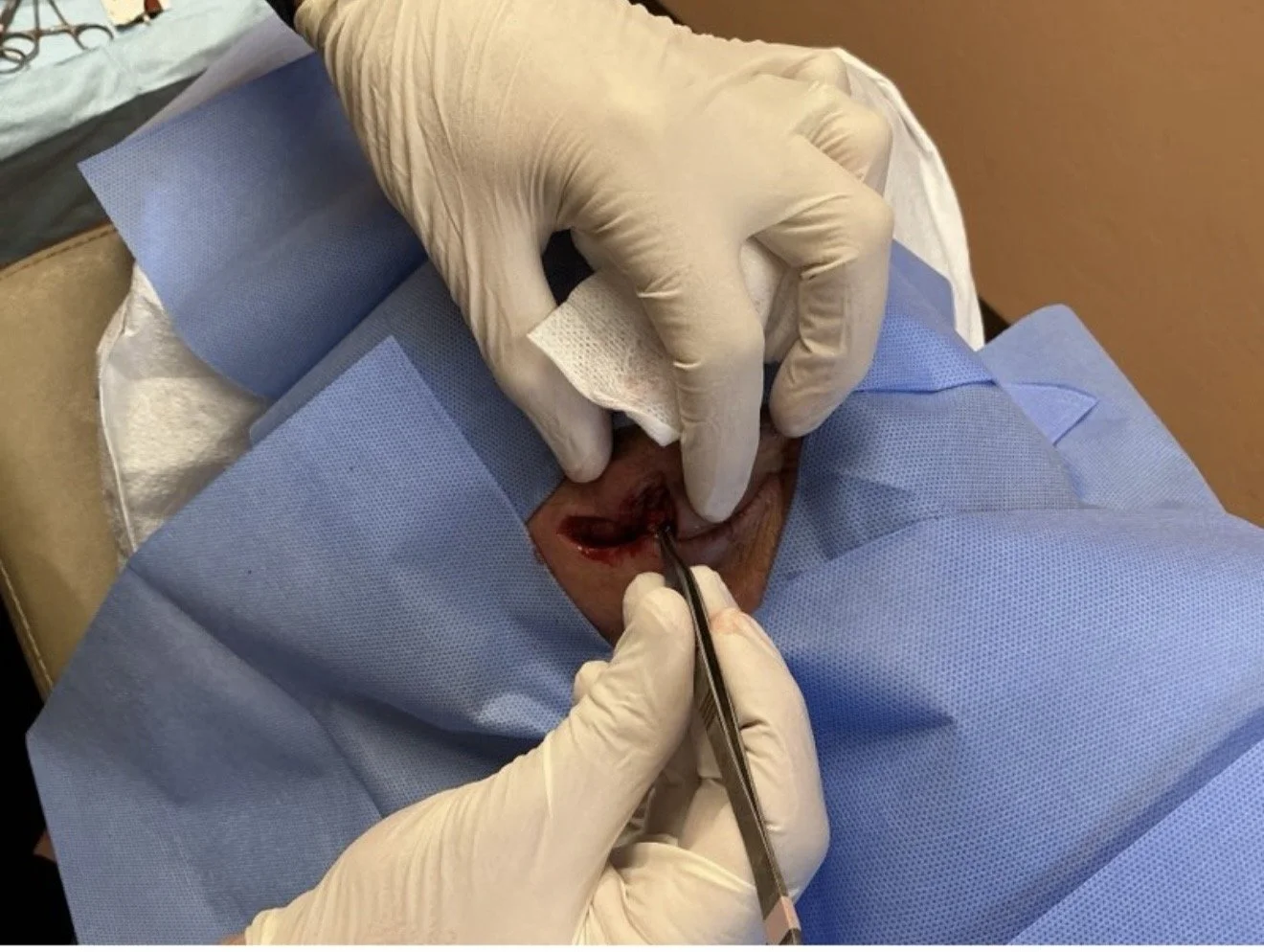 Medical professional wearing gloves performs a dental procedure on a patient's mouth using dental tools, with the patient draped in a blue surgical cloth.