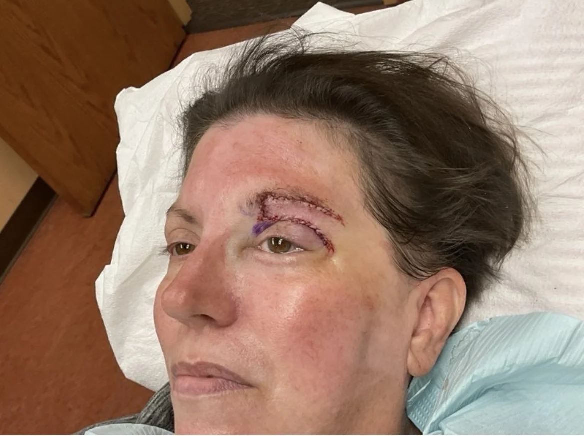 A woman lying in a hospital bed with visible stitches and bruising around her forehead and eye after undergoing facial surgery or trauma treatment.