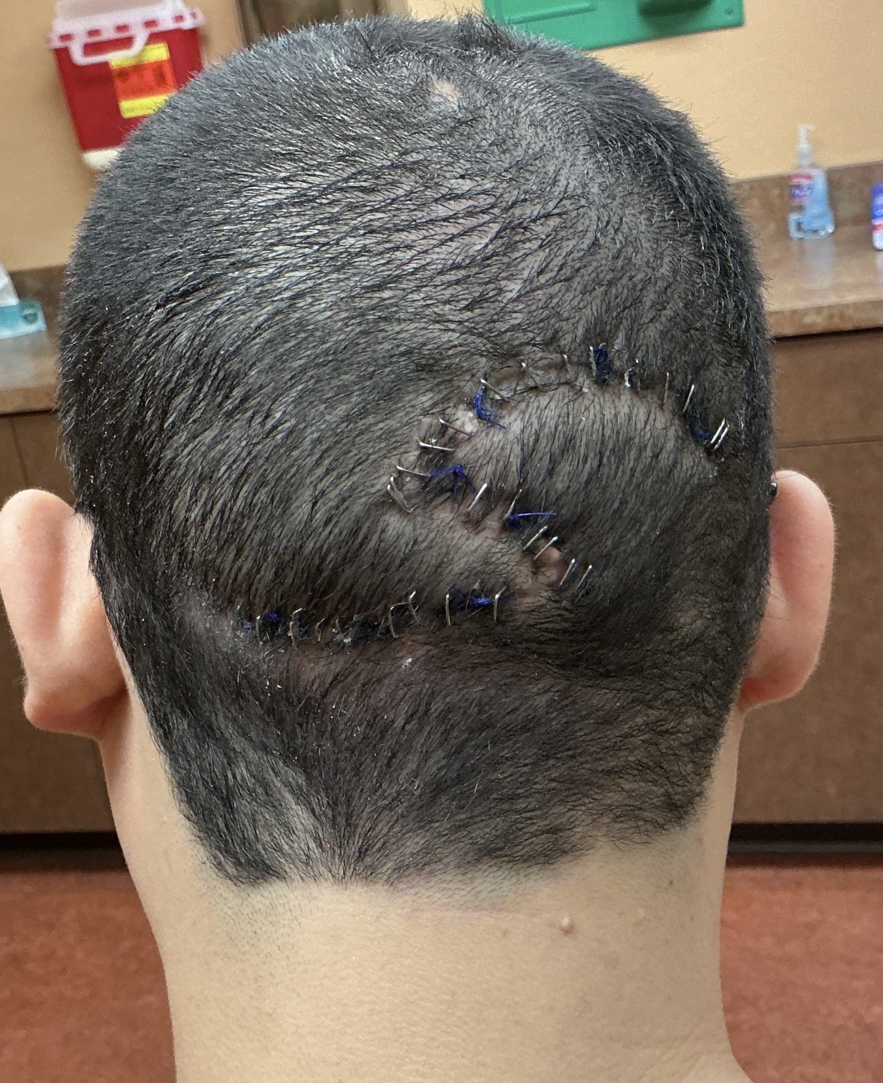 A person's head with a recent hair transplant, featuring multiple small stitches or scars along the transplanted hairline. The person is seated in a clinic or medical setting, with a fire extinguisher and medicine bottles visible in the background.