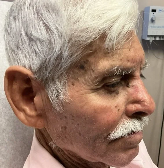 Close-up of an elderly man with gray hair and a mustache, showing skin conditions and age spots on his face, in an indoor setting.