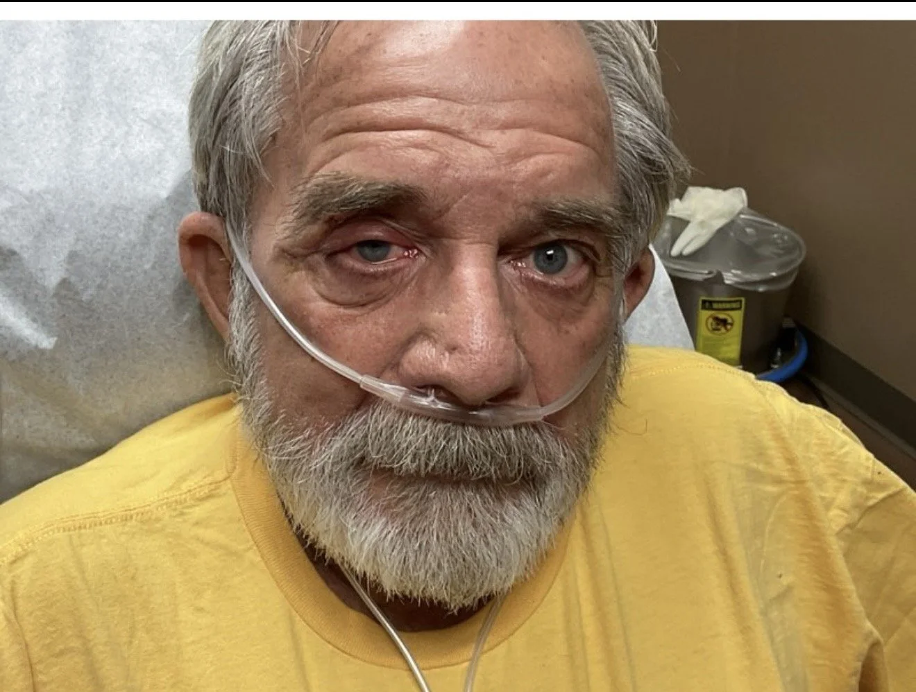 An elderly man with gray hair and a beard, lying in a hospital bed with an oxygen tube in his nose, wearing a yellow shirt.