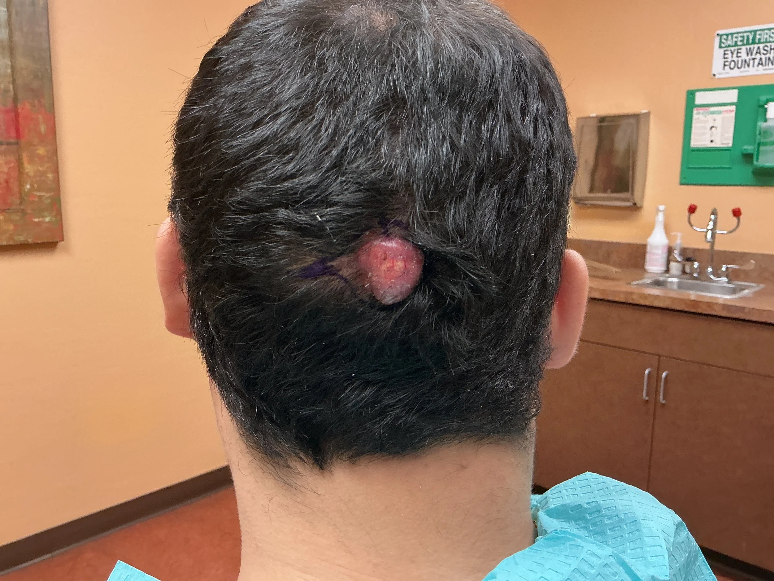 Back view of a person with dark hair, with a large swollen and infected lump on the back of their head, in a restroom with beige walls, safety signs, and dental supplies.