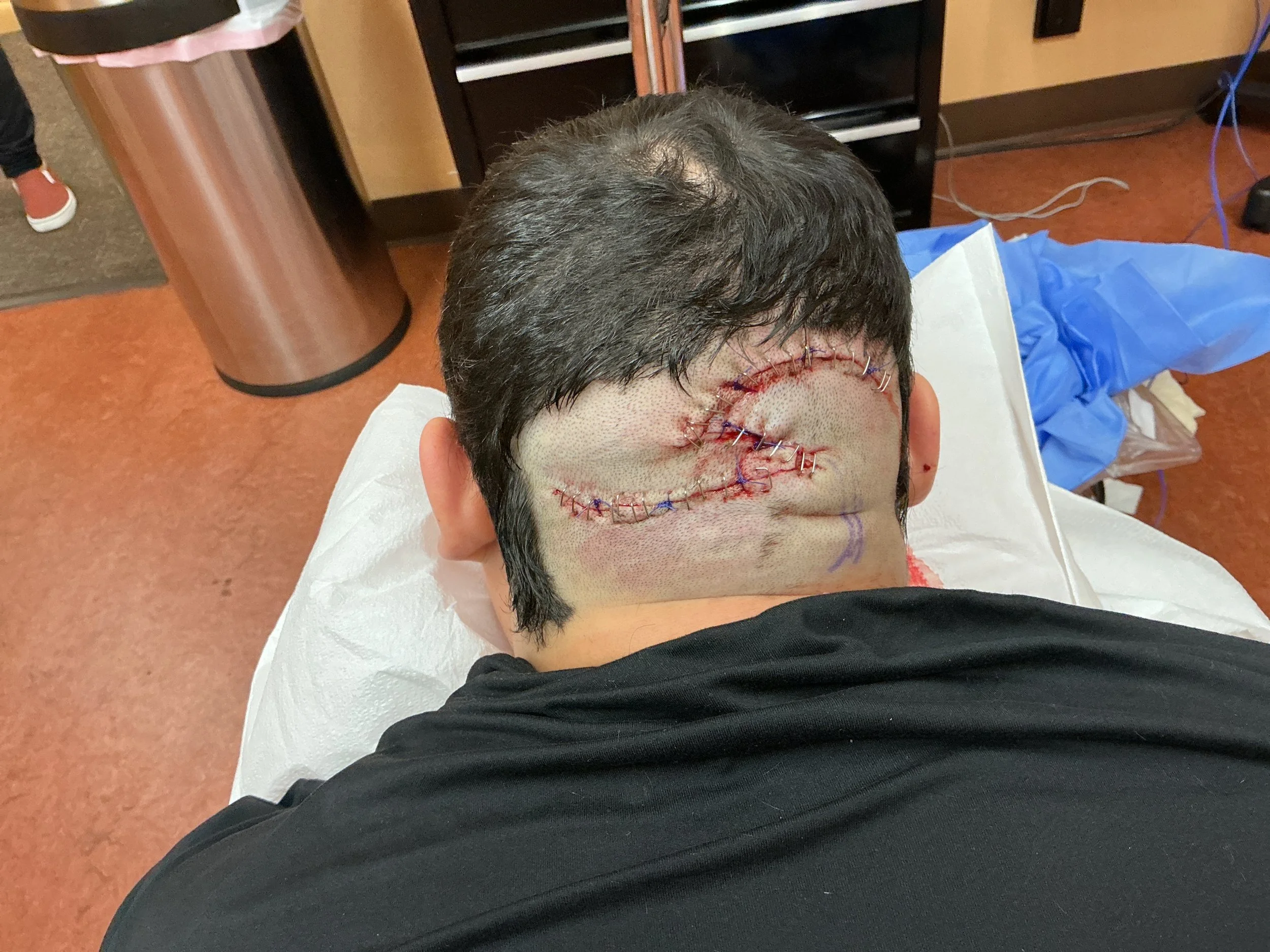 Person with a stitched, swollen eye in a medical setting, lying on an examination table.