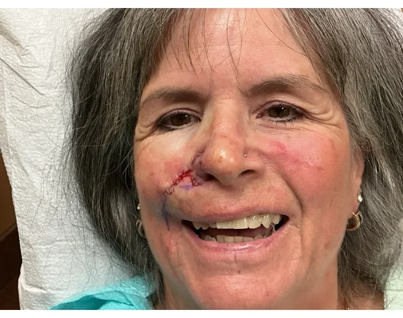 Close-up of a woman with gray hair showing her face with a recent surgical scar on her left cheek, smiling in a medical setting.