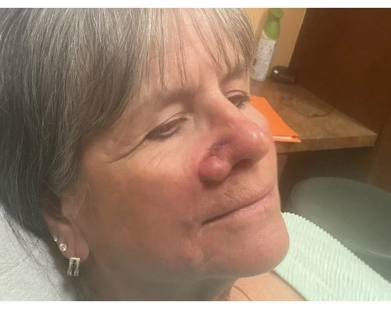 Close-up of an older woman's face with a swollen nose, lying on a medical bed in a treatment room.