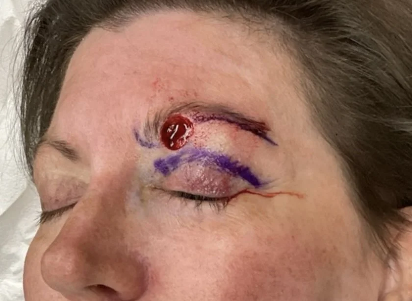 Close-up of a person's face with a closed eye, showing a fresh surgical wound above the eyelid and bruising with purple markings around it.